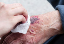 Grzybica skóry dłoni – główne przyczyny Grzybica skóry dłoni - główne przyczyny